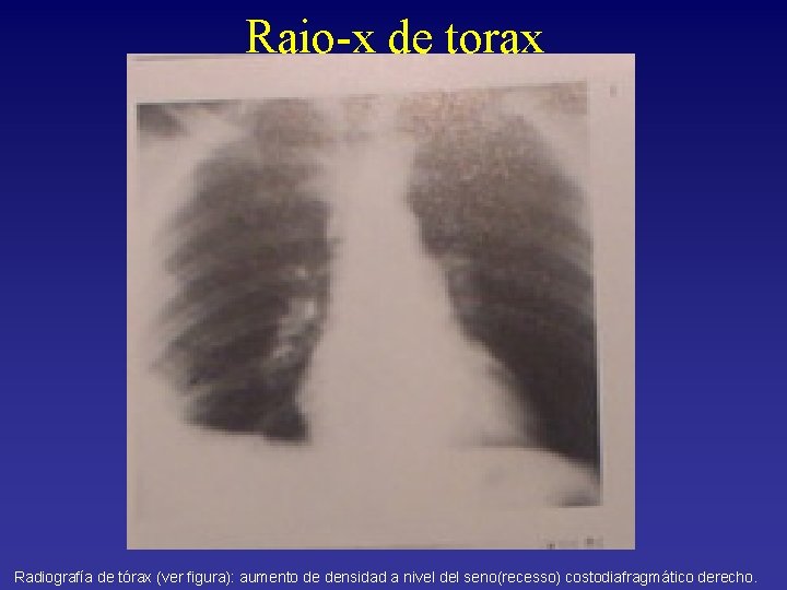 Raio-x de torax Radiografía de tórax (ver figura): aumento de densidad a nivel del