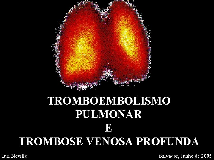 TROMBOEMBOLISMO PULMONAR E TROMBOSE VENOSA PROFUNDA Iuri Neville Salvador, Junho de 2005 