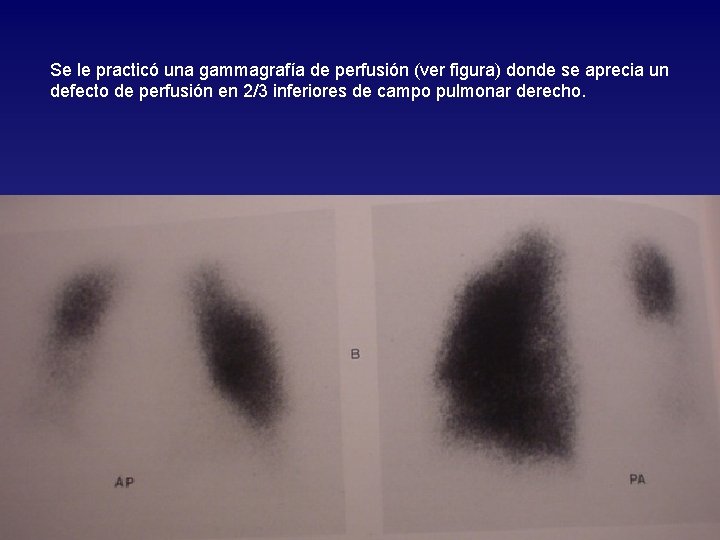 Se le practicó una gammagrafía de perfusión (ver figura) donde se aprecia un defecto