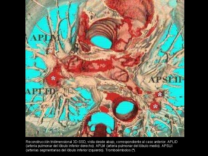 Reconstrucción tridimensional 3 D-SSD, vista desde abajo, correspondiente al caso anterior. APLID (arteria pulmonar