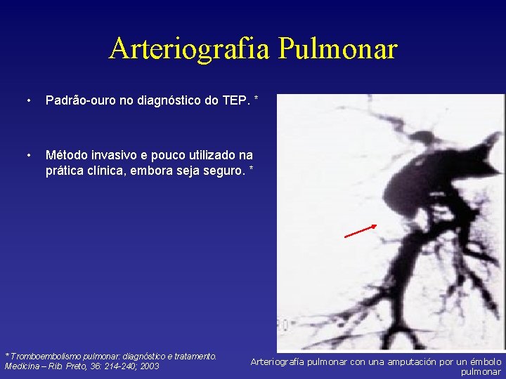 Arteriografia Pulmonar • Padrão-ouro no diagnóstico do TEP. * • Método invasivo e pouco