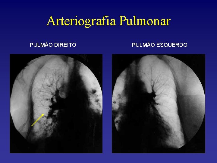 Arteriografia Pulmonar PULMÃO DIREITO PULMÃO ESQUERDO 