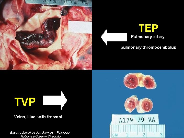 TEP Pulmonary artery, pulmonary thromboembolus TVP Veins, iliac, with thrombi Bases patológicas doenças –