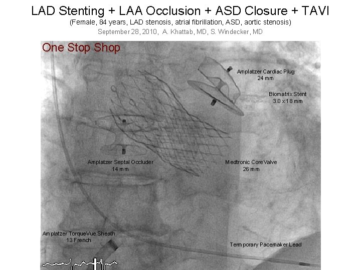 LAD Stenting + LAA Occlusion + ASD Closure + TAVI (Female, 84 years, LAD