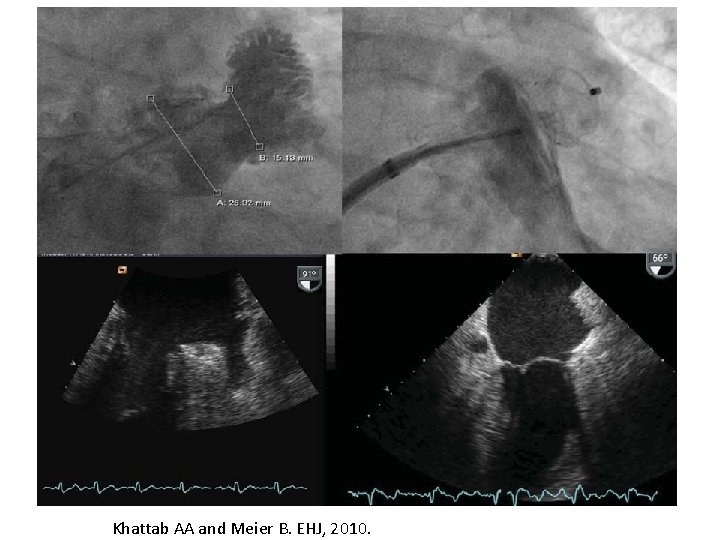 Khattab AA and Meier B. EHJ, 2010. 