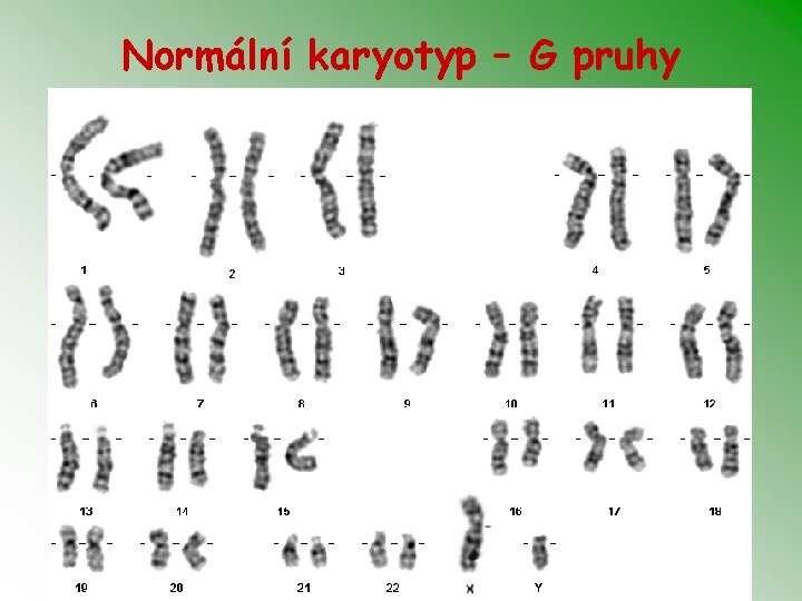 Normální karyotyp – G pruhy 