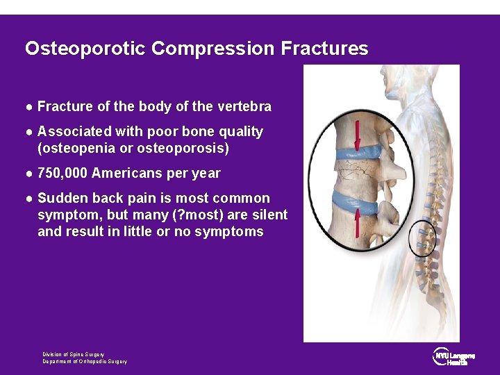 Osteoporotic Compression Fractures ● Fracture of the body of the vertebra ● Associated with