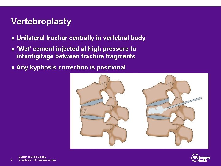 Vertebroplasty ● Unilateral trochar centrally in vertebral body ● ‘Wet’ cement injected at high