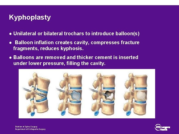 Kyphoplasty ● Unilateral or bilateral trochars to introduce balloon(s) ● Balloon inflation creates cavity,