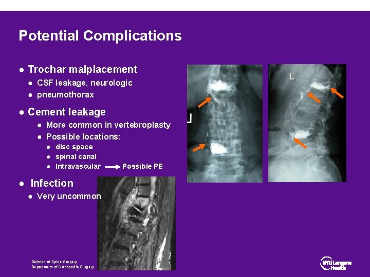 Potential Complications ● Trochar malplacement ● CSF leakage, neurologic ● pneumothorax ● Cement leakage