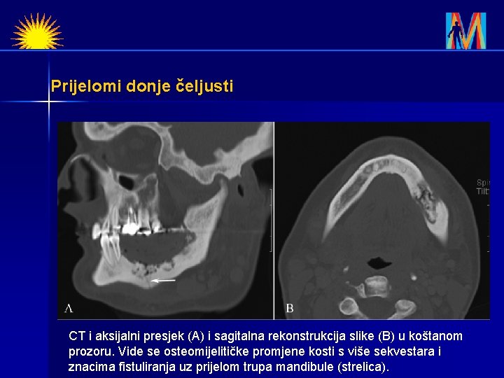 Prijelomi donje čeljusti CT i aksijalni presjek (A) i sagitalna rekonstrukcija slike (B) u