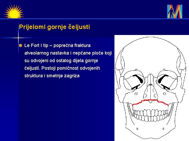 Prijelomi gornje čeljusti Le Fort I tip – poprečna fraktura alveolarnog nastavka i nepčane