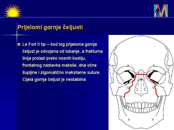 Prijelomi gornje čeljusti Le Fort II tip – kod tog prijeloma gornja čeljust je