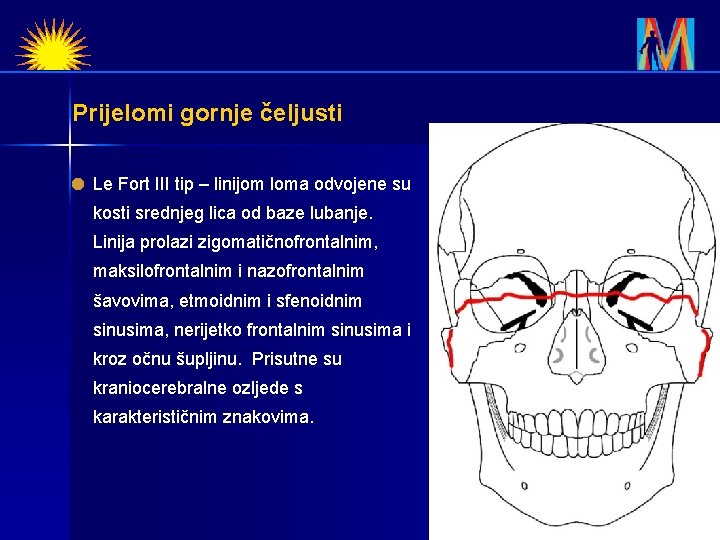 Prijelomi gornje čeljusti Le Fort III tip – linijom loma odvojene su kosti srednjeg