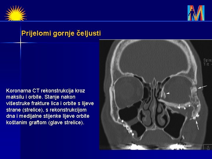 Prijelomi gornje čeljusti Koronarna CT rekonstrukcija kroz maksilu i orbite. Stanje nakon višestruke frakture