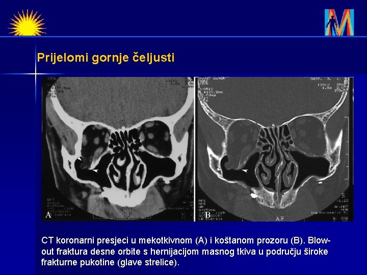 Prijelomi gornje čeljusti CT koronarni presjeci u mekotkivnom (A) i koštanom prozoru (B). Blowout