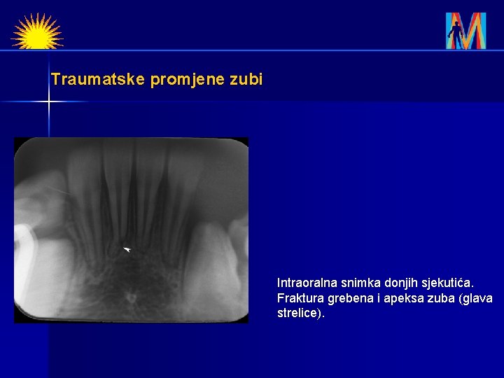 Traumatske promjene zubi Intraoralna snimka donjih sjekutića. Fraktura grebena i apeksa zuba (glava strelice).