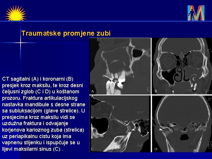 Traumatske promjene zubi CT sagitalni (A) i koronarni (B) presjek kroz maksilu, te kroz