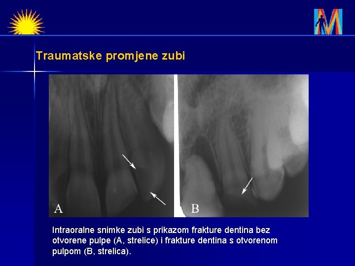 Traumatske promjene zubi Intraoralne snimke zubi s prikazom frakture dentina bez otvorene pulpe (A,