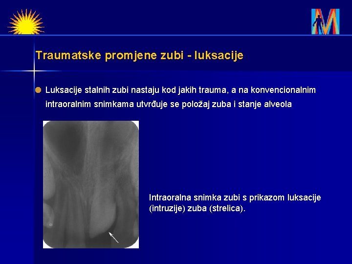 Traumatske promjene zubi - luksacije Luksacije stalnih zubi nastaju kod jakih trauma, a na