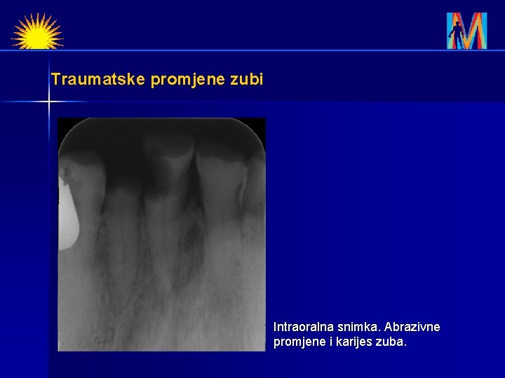 Traumatske promjene zubi Intraoralna snimka. Abrazivne promjene i karijes zuba. 