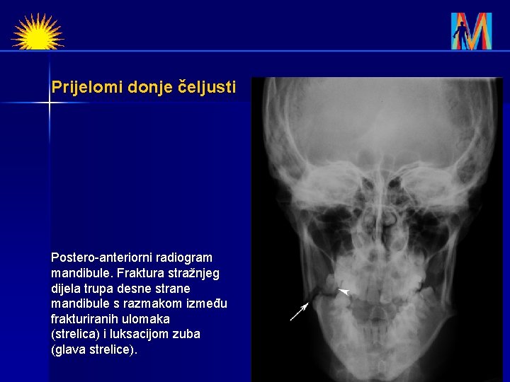 Prijelomi donje čeljusti Postero-anteriorni radiogram mandibule. Fraktura stražnjeg dijela trupa desne strane mandibule s