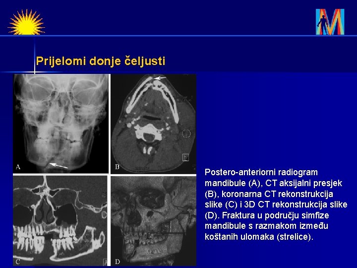 Prijelomi donje čeljusti Postero-anteriorni radiogram mandibule (A), CT aksijalni presjek (B), koronarna CT rekonstrukcija