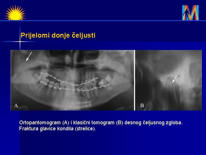 Prijelomi donje čeljusti Ortopantomogram (A) i klasični tomogram (B) desnog čeljusnog zgloba. Fraktura glavice