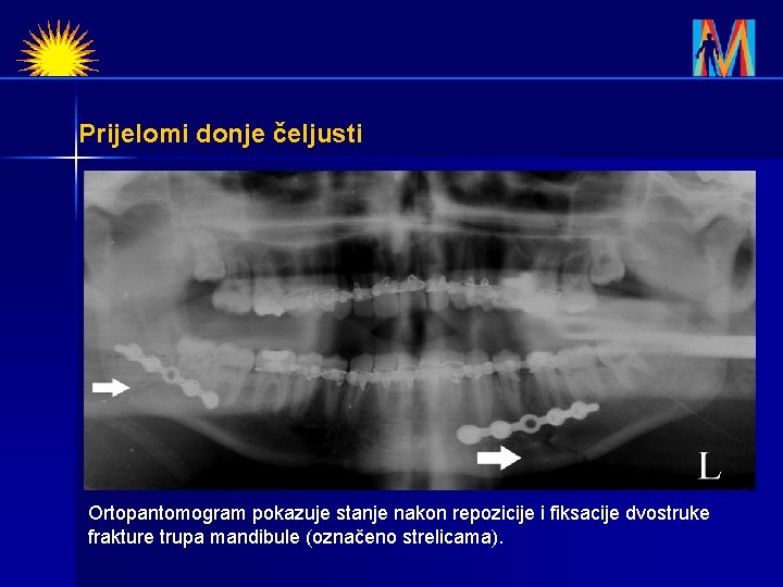 Prijelomi donje čeljusti Ortopantomogram pokazuje stanje nakon repozicije i fiksacije dvostruke frakture trupa mandibule