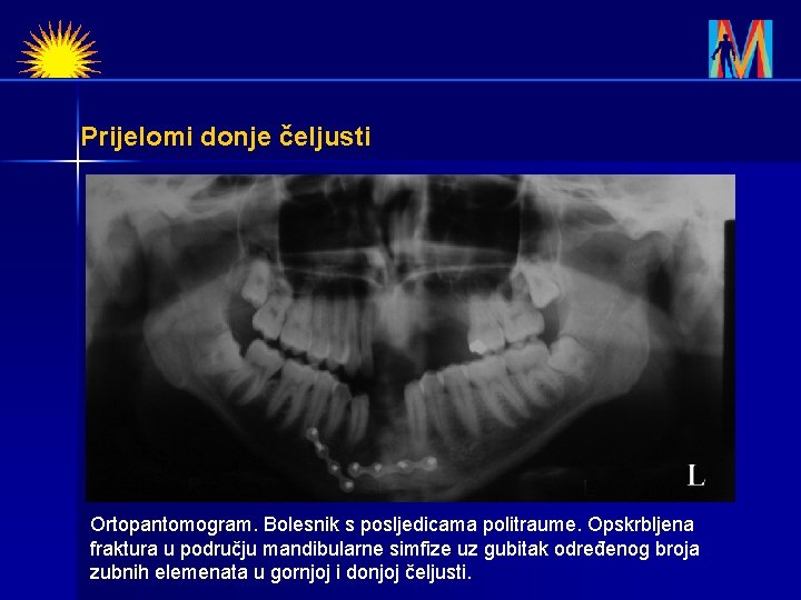 Prijelomi donje čeljusti Ortopantomogram. Bolesnik s posljedicama politraume. Opskrbljena fraktura u području mandibularne simfize