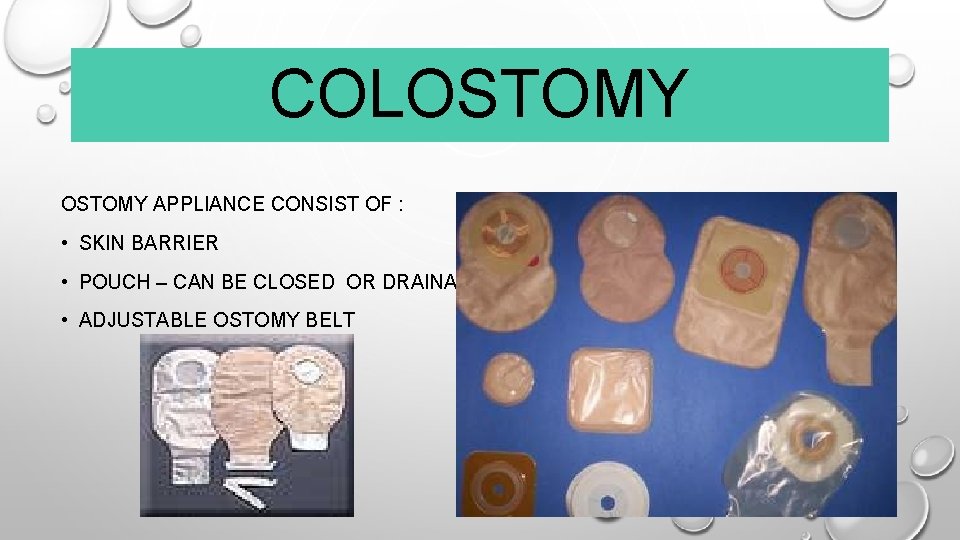 COLOSTOMY APPLIANCE CONSIST OF : • SKIN BARRIER • POUCH – CAN BE CLOSED