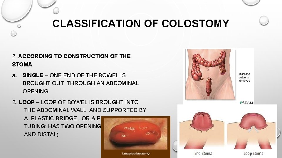 CLASSIFICATION OF COLOSTOMY 2. ACCORDING TO CONSTRUCTION OF THE STOMA a. SINGLE – ONE