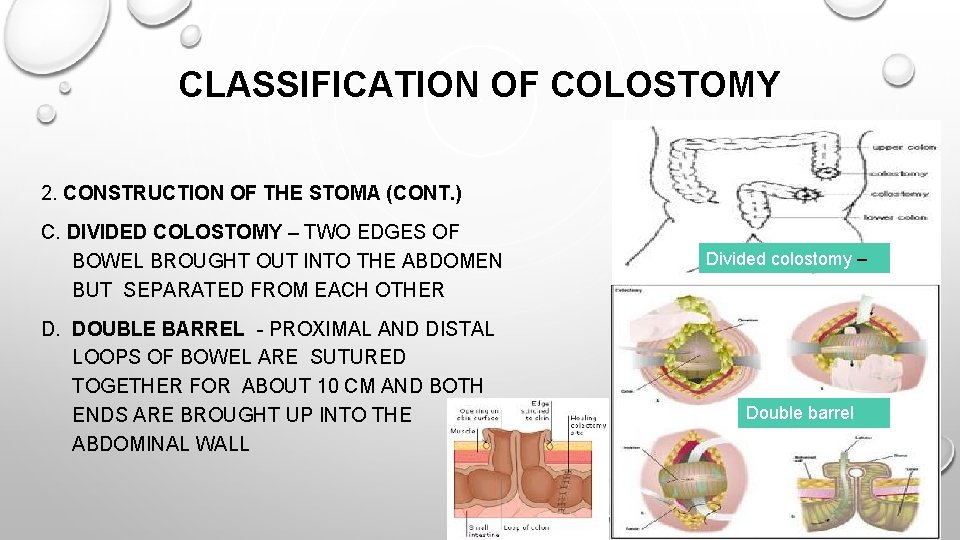 CLASSIFICATION OF COLOSTOMY 2. CONSTRUCTION OF THE STOMA (CONT. ) C. DIVIDED COLOSTOMY – CLASSIFICATION OF COLOSTOMY 2. CONSTRUCTION OF THE STOMA (CONT. ) C. DIVIDED COLOSTOMY –