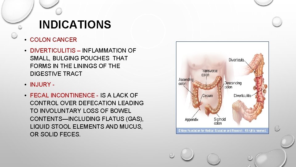 INDICATIONS • COLON CANCER • DIVERTICULITIS – INFLAMMATION OF SMALL, BULGING POUCHES THAT FORMS INDICATIONS • COLON CANCER • DIVERTICULITIS – INFLAMMATION OF SMALL, BULGING POUCHES THAT FORMS