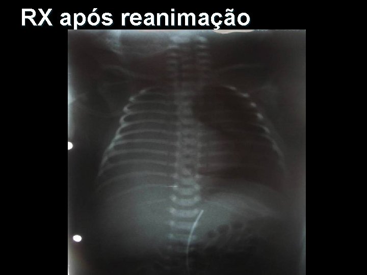 RX após reanimação 