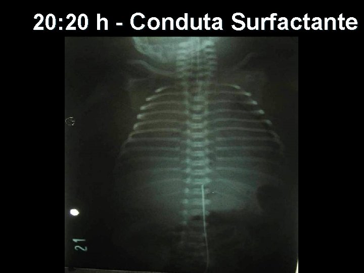 20: 20 h - Conduta Surfactante 