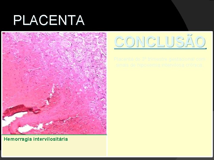 PLACENTA CONCLUSÃO Placenta do 3º trimestre gestacional com sinais de hipoxemia intervilosa crônica. Hemorragia