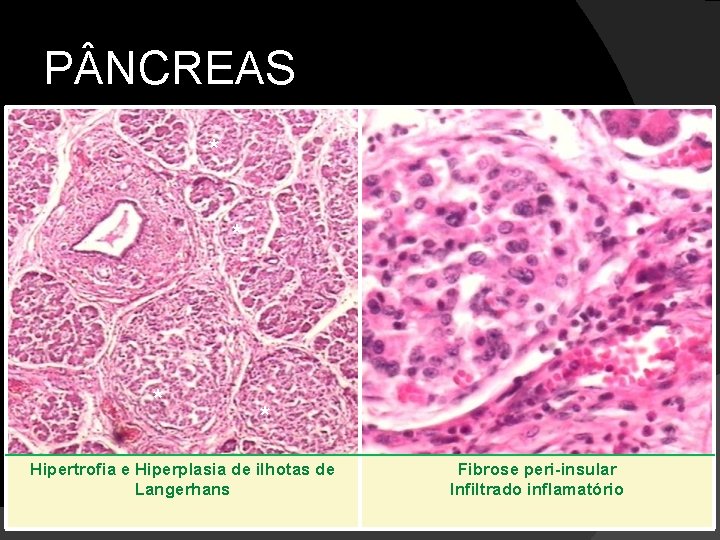 P NCREAS * * Hipertrofia e Hiperplasia de ilhotas de Langerhans Fibrose peri-insular Infiltrado