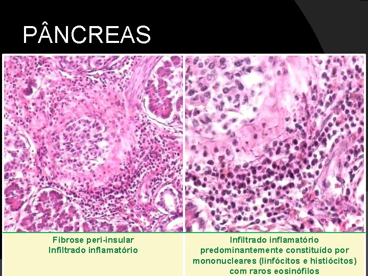 P NCREAS Fibrose peri-insular Infiltrado inflamatório predominantemente constituído por mononucleares (linfócitos e histiócitos) com