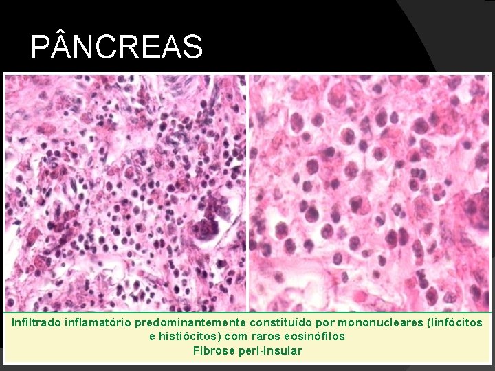 P NCREAS Infiltrado inflamatório predominantemente constituído por mononucleares (linfócitos e histiócitos) com raros eosinófilos