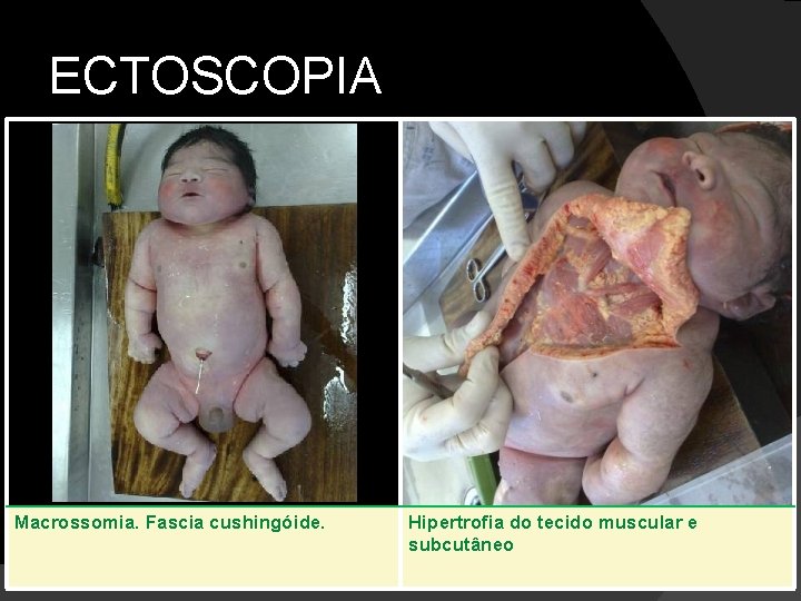 ECTOSCOPIA Macrossomia. Fascia cushingóide. Hipertrofia do tecido muscular e subcutâneo 