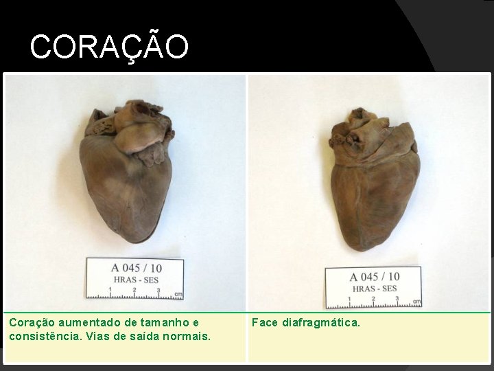 CORAÇÃO Coração aumentado de tamanho e consistência. Vias de saída normais. Face diafragmática. 