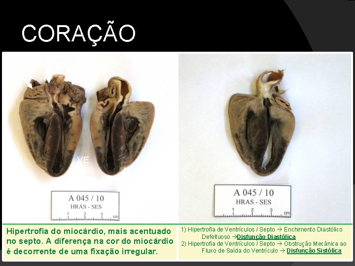 CORAÇÃO AD VD Ao VE Hipertrofia do miocárdio, mais acentuado no septo. A diferença