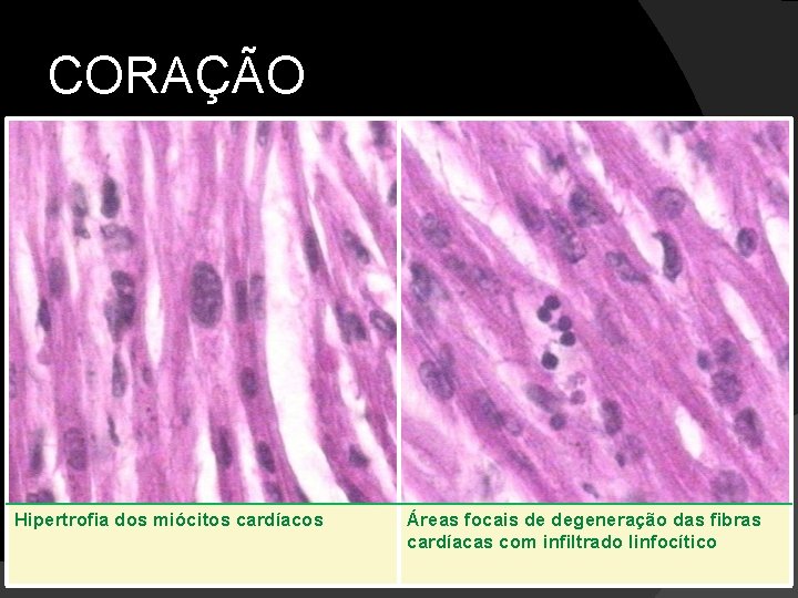 CORAÇÃO Hipertrofia dos miócitos cardíacos Áreas focais de degeneração das fibras cardíacas com infiltrado