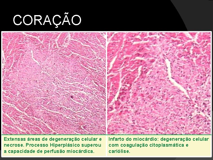 CORAÇÃO Extensas áreas de degeneração celular e necrose. Processo Hiperplásico superou a capacidade de