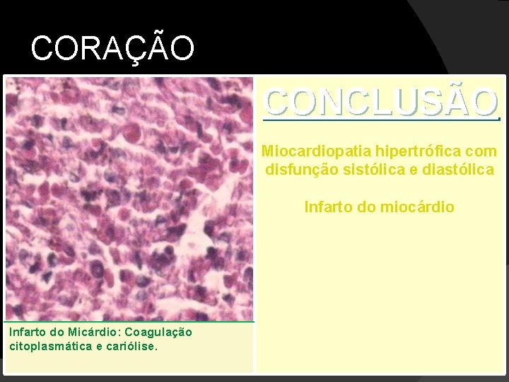 CORAÇÃO CONCLUSÃO Miocardiopatia hipertrófica com disfunção sistólica e diastólica Infarto do miocárdio Infarto do