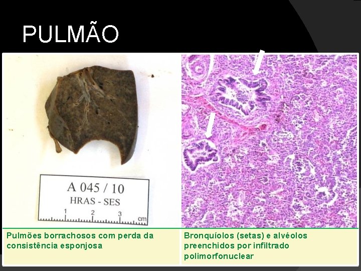 PULMÃO Pulmões borrachosos com perda da consistência esponjosa Bronquíolos (setas) e alvéolos preenchidos por