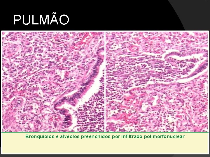 PULMÃO Bronquíolos e alvéolos preenchidos por infiltrado polimorfonuclear 