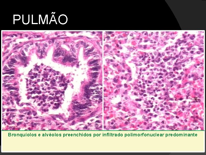 PULMÃO Bronquíolos e alvéolos preenchidos por infiltrado polimorfonuclear predominante 