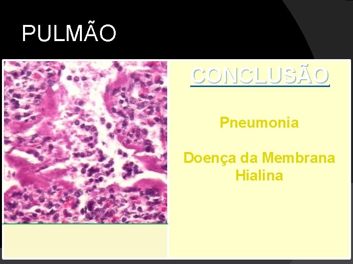 PULMÃO CONCLUSÃO Pneumonia Doença da Membrana Hialina 